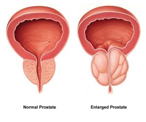 cuantos lobulos tiene la prostata prostata congestionata